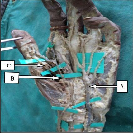 each other. Fig 14: ulnar artery contributing arch formation A Ulnar artery Co-dominant types 1. Ulnar + radiopalmar type in 12 hands (7.