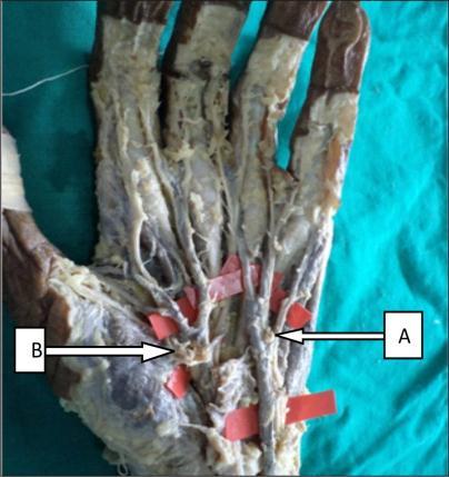Fig 18: Arch formed by ulnar and median artery A-Ulnar artery; B- median artery 5.