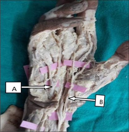 82%) (Fig 19) Superficial branch of ulnar artery and persistent median artery enter the hand but do not