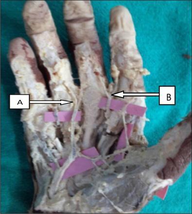 st DMA Fig 19: Arch formed by ulnar, median and 1 st dorsal metacarpal artery A- Ulnar artery; B Median