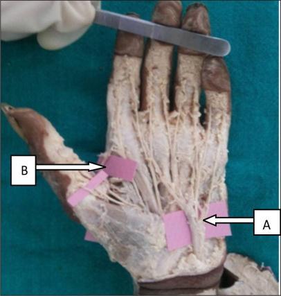 view: 1 st dorsal metacarpal artery C- 1 st dorsal metacarpal artery 6. Ulnar +radial proper 2 hands (1.