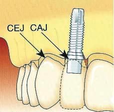 Four categories were identified [Figure 1]: Normal: Interdental papilla fills embrasure space to the apical extent of the interdental contact point/area.