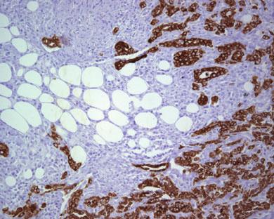 436 PT Cagle and TC Allen Figure 7 Pankeratin stain highlights epithelioid diffuse malignant mesothelioma