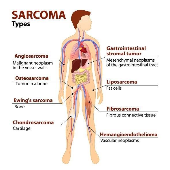 Sarcoma -