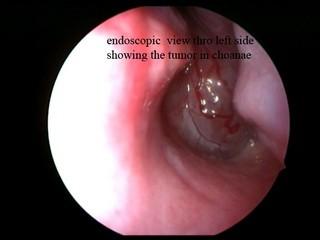 Nasal Endoscopy: CT scan and MRI scans were