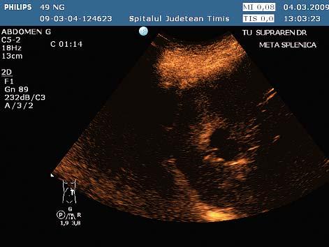 spleen, around 2 cm, in a patient diagnosed with a right adrenal