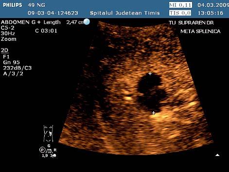 Portal phase the splenic lesion has no enhancement in the arterial