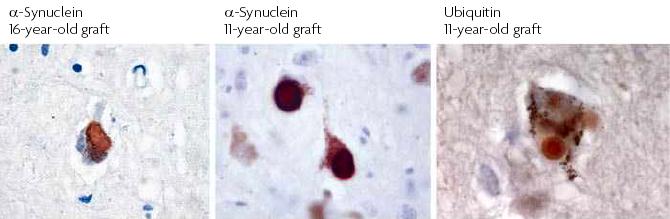 Lewy bodies develop in grafted neurons in Parkinson disease α-synuclein 16-year-old graft