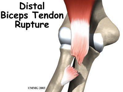 These partial tears are thought to progress to complete tears. In complete tears, the tendon ruptures away from the radial tuberosity and retracts.