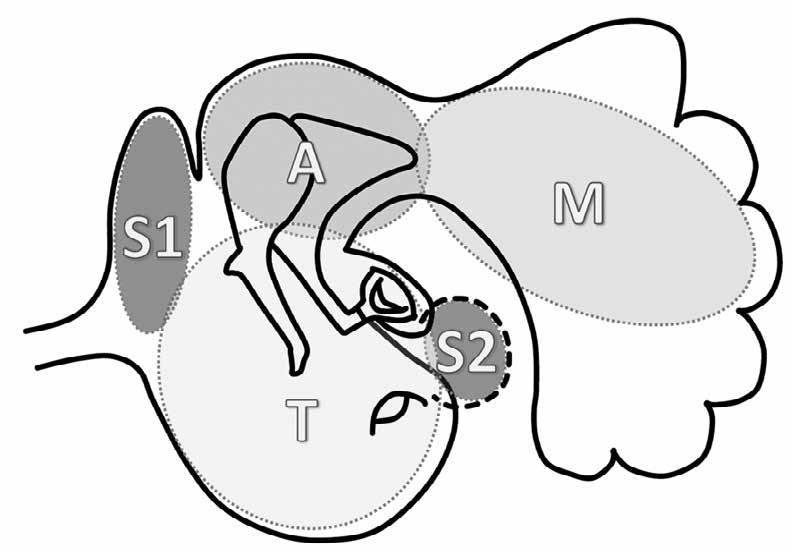 Divisions of the middle ear space (STAM system) Difficult access sites (S) S1, the supratubal recess (also