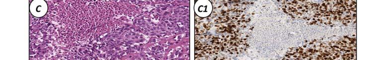 1C + 1C1: Type C neuroendocrine carcinoma.