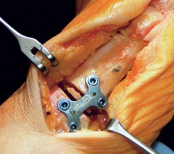 BOW Opening wedge osteotomy plate for bunion correction Varying spacer widths allow