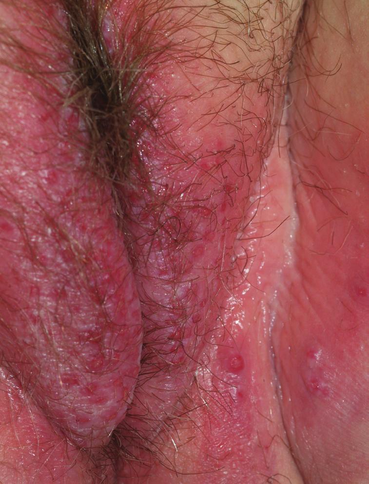 FIGURE 2 Contact dermatitis Redness and erosions are typical of an acute contact dermatitis, and eroded papules are especially common in contact dermatitis of benzocaine.