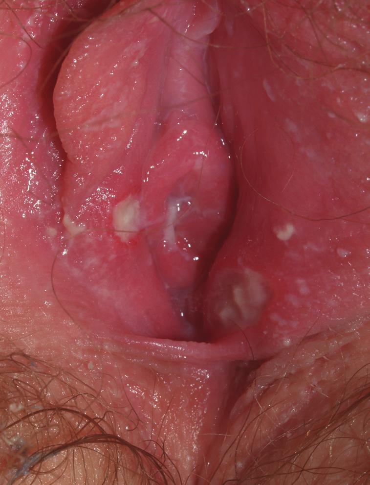 Benign vulvar conditions Aphthae are uncommon and underrecognized on the vulva, and genital aphthae are usually much larger than oral aphthae FIGURE 3 Vulvar aphthae Well-demarcated ulcerations with