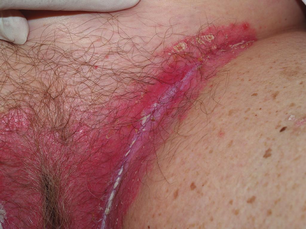Benign vulvar conditions CONTINUED FROM PAGE 35 FIGURE 5 Inverse psoriasis vagina nightly, or it can be compounded at 100 or 200 mg, if needed.