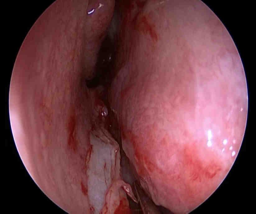 Definition Endoscopic septoplasty is a fast developing concept and gaining