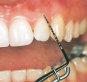 Objective evaluation of periodontal status is only possible when using pressuresensitive periodontal probes.