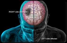 hemorrhages are the most common type after TBI (traumatic Brain Injury), and they are a cause of further brain damage that can lead