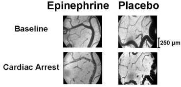 Epinephrine: Increases arterial pressure