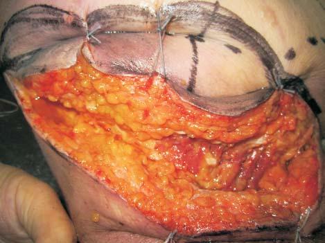 MATERIALS AND METHODS During the dissection of one fresh, female cadaver, age 67, a free inferior gluteal flap was taken from gluteal region, using loupe magnification.