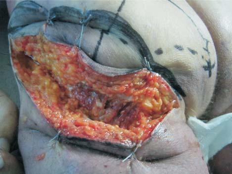 The Inferior Gluteal Flap - Breast Reconstruction - Anatomic Dissection on a Cadaver 203 Figure 4.