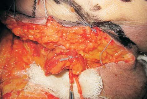 A portion of the gluteus minimus muscle will be lifted along with the superjacent cutaneous fat-pad flap, to protect the vascular pedicle and its