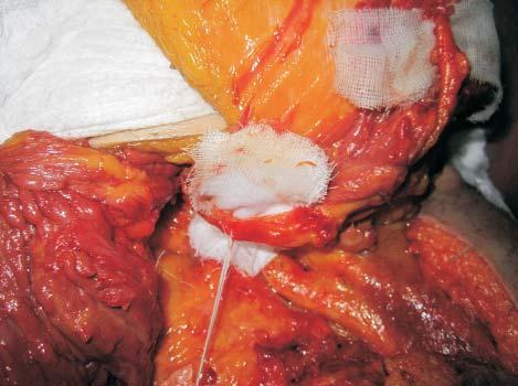 The Inferior Gluteal Flap - Breast Reconstruction - Anatomic Dissection on a Cadaver 205 Figure 15.
