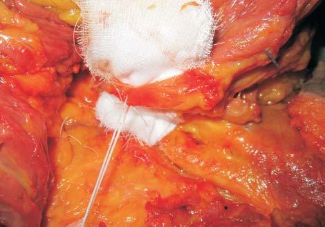 The tensing of the superior gluteal pedicle facilitates its dissection towards its origin (situated in the lower part of the