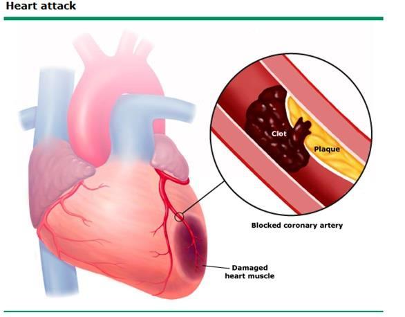 Acute Myocardial Infarction Presentation: Like Angina but more severe & more prolonged (>30 minutes) acute typical chest pain usually associated with dyspnea, nausea.