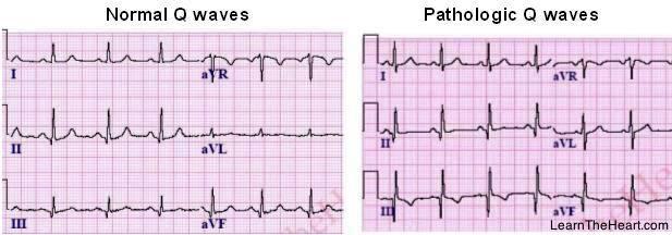 * Q wave MI - Pathologic Q waves (>0.04 msec in duration and >1/3 the height of R wave) - Early hyperacute T resolves after minutes as ST segment elevation develops.