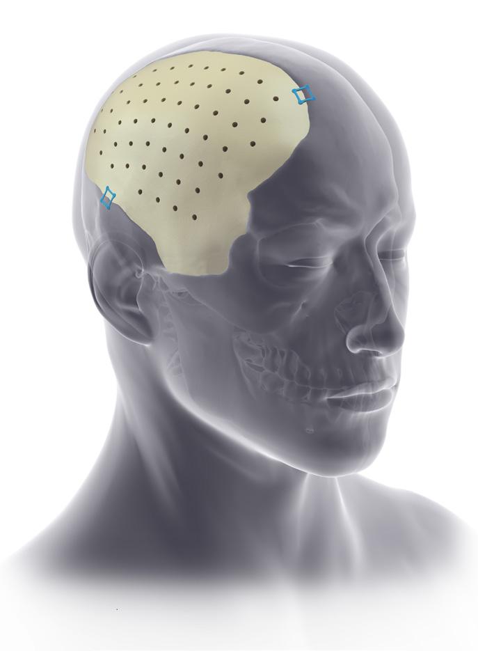 Pterional PLUS is designed to serve as both a safe and effective solution for temporal hollowing,