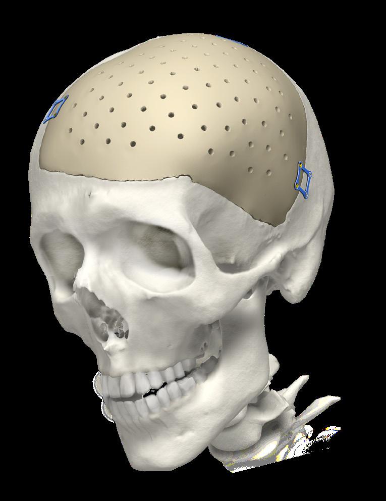 PEEK Precise fit. Excellent strength. PEEK patient specific implants are designed with exacting parameters to optimize the boneto-implant interface.