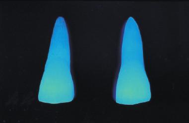Moreover, a natural tooth is composed of enamel, dentine and dental pulp, each of which exhibits different fluorescence. succeeds in faithfully reproducing the fluorescence of natural teeth.