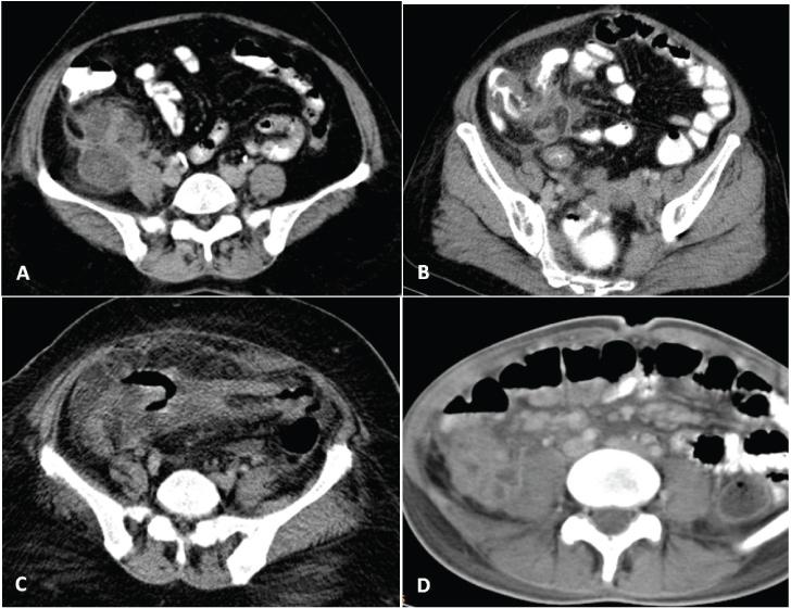 [Table/Fig-3]: Appendicular phlegmonous masses (A to C) showing abscesses (A), ill-defined fluid collections and bowel wall thickening (B), extraluminal air, omental inflammation and thickening (C).