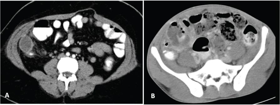 Axial CT image of another patient (B) showing appendicular abscess with extraluminal air pockets.