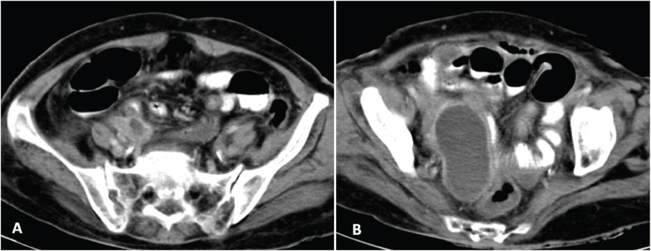terminal ileal thickening seen in 15 patients. Small bowel dilatation was present in 20 (35.