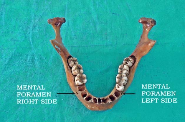 The incidences of the accessory mental foramen were also observed (figure 2, 3).
