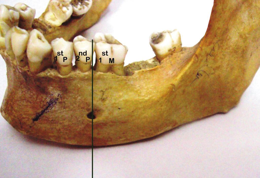 border of the mandible with a digital vernier caliper and calculated the size of the mental foramen (Igbigbi and Lebona, 25) (Fig. 1): VD: Vertical diameter of the foramen = CD-(Cc+Dd).