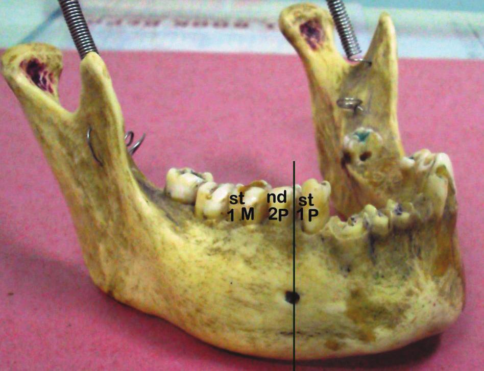 Morphology and morphometry of the mental foramen in dry adult human mandibles from central India and their clinical correlation Fig. 4. Mandible showing the mental foramen lying in position III.