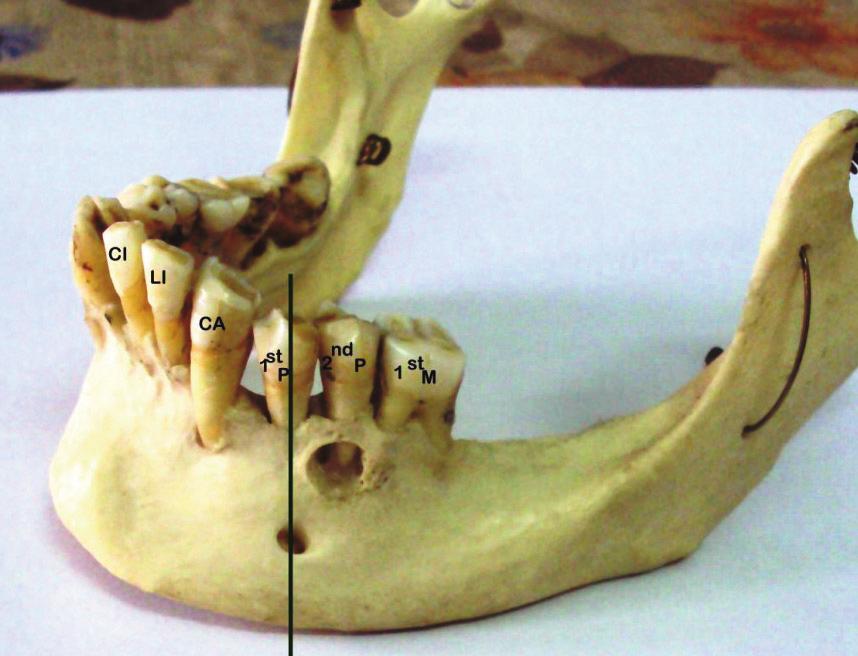 3), III (Fig. Fig. 5. Mandible showing the mental foramen lying in position II.