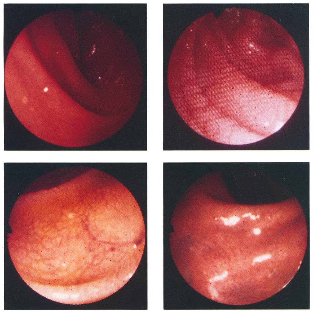The features needed to arrive at a diagnosis were loss of villi with flattening of the mucosal surface, hyperplasia of the crypts, presence of cytologically abnormal surface cells, and in- flammation