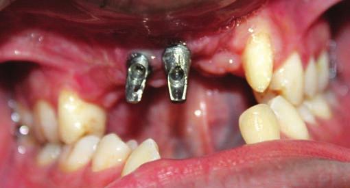 A tooth and implant-supported fixed partial denture was constructed involving implants and maxillary left canine.
