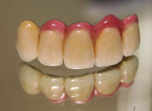 The fixed partial denture was then cemented using glass ionomer cement (GC Fugi CEM, GC Corporation, Tokyo, Japan).
