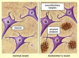 Presumed Etiology Alzheimer disease Amyloid