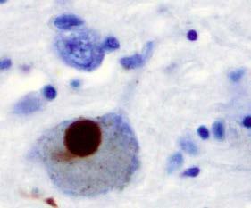 body and Parkinson dementia Cytoplasmic α-synuclein