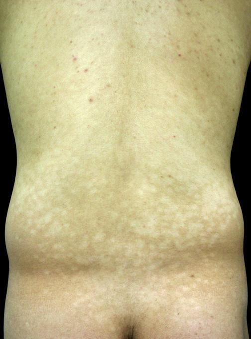 SW Hwang, et al MATERIALS AND METHODS Patients Patients with acquired, non-scaly, confluent, hypopigmented macules and with no history of skin disease who were treated in the Department of