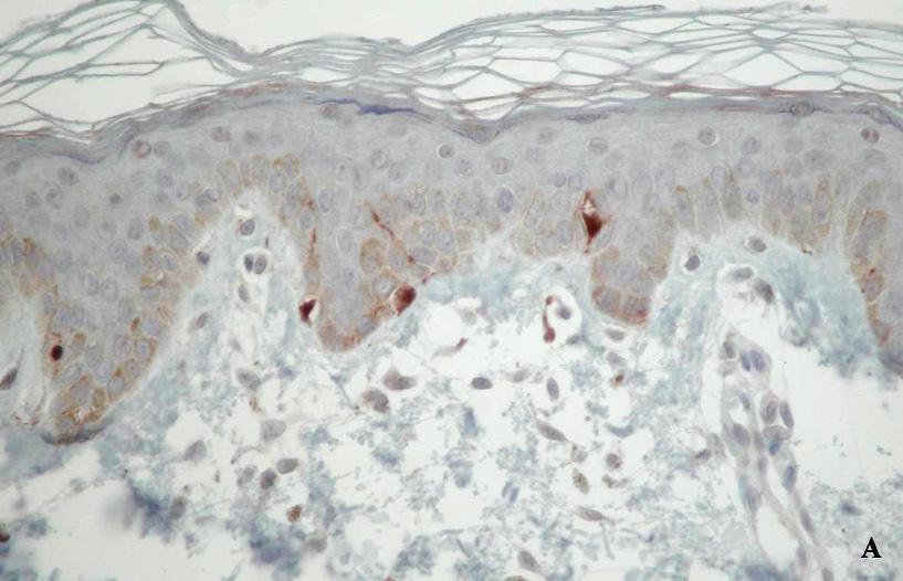 Progressive Macular Hypomelanosis in Korean Patients: A Clinicopathologic Study Fig.. Case.