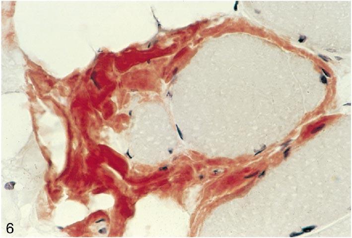 Figure 6. Patient 8. Muscle biopsy demonstrating endomysial amyloid deposition highlighted using a Congo red stain.