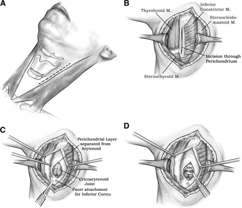 ARYTENOIDECTOMY Permanent and irreversible Glottis expanded in transverse axis - Woodman s approach (Lateral neck approach) -