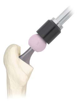 Remove the Trial Head and dry the implant trunnion with a laparatomy sponge or sterile towel.